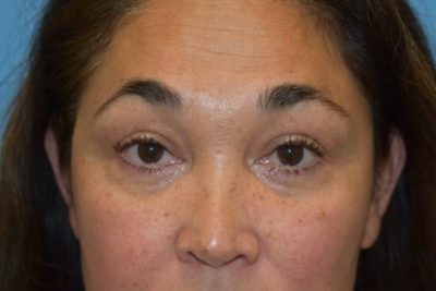 Blepharoplasty (Eyelid Surgery)