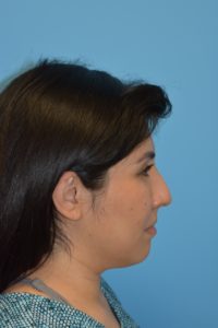 Chin Augmentation