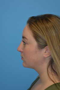 Rhinoplasty