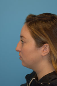 Rhinoplasty