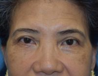 Blepharoplasty (Eyelid Surgery)