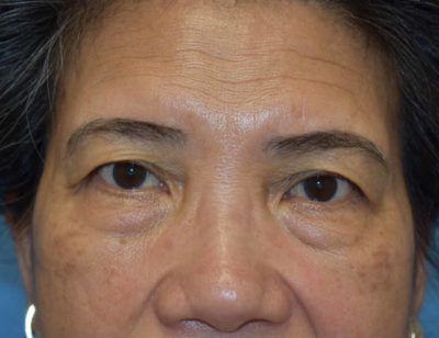 Blepharoplasty (Eyelid Surgery)