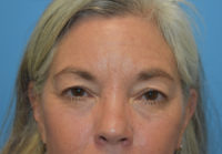 Blepharoplasty (Eyelid Surgery)