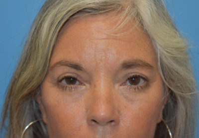 Blepharoplasty (Eyelid Surgery)