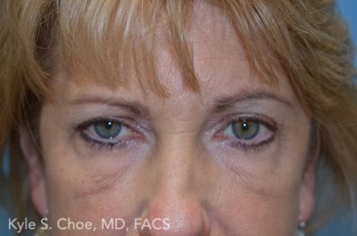 Endoscopic Brow Lift