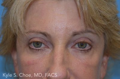 Endoscopic Brow Lift