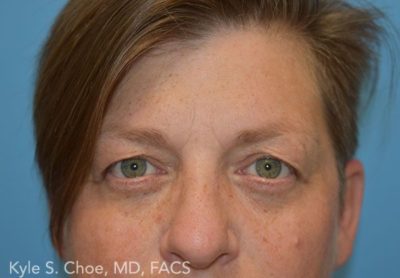 Blepharoplasty (Eyelid Surgery)