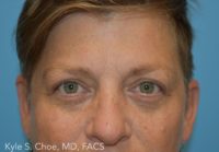 Blepharoplasty (Eyelid Surgery)