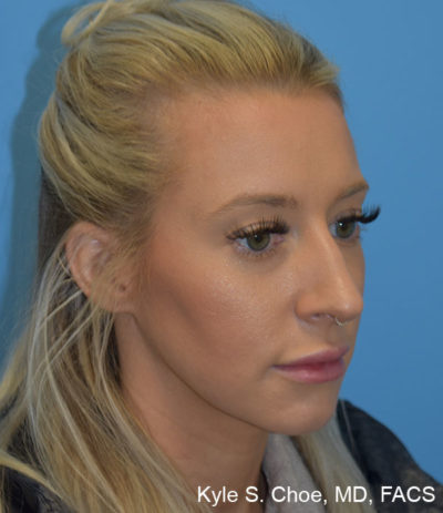 Rhinoplasty