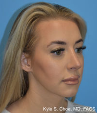 Rhinoplasty