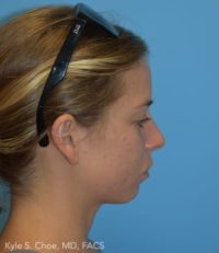 Chin Augmentation