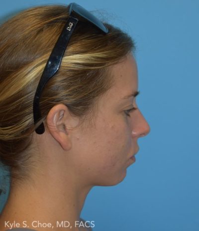 Chin Augmentation