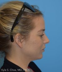 Chin Augmentation