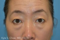 Blepharoplasty (Eyelid Surgery)