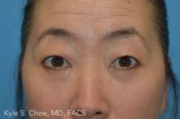 Blepharoplasty (Eyelid Surgery)