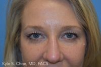 Blepharoplasty (Eyelid Surgery)