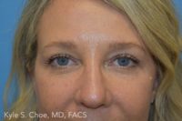 Blepharoplasty (Eyelid Surgery)