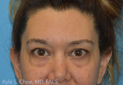 Blepharoplasty (Eyelid Surgery)