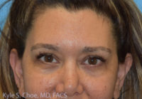 Blepharoplasty (Eyelid Surgery)