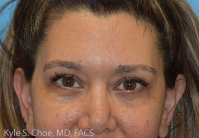 Blepharoplasty (Eyelid Surgery)