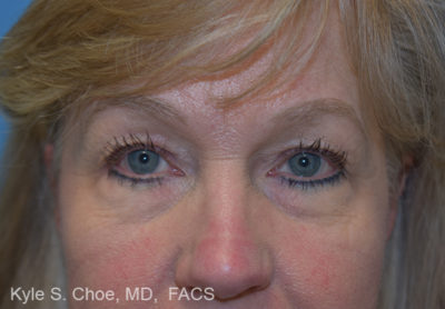 Blepharoplasty (Eyelid Surgery)