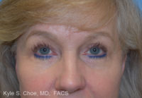 Blepharoplasty (Eyelid Surgery)