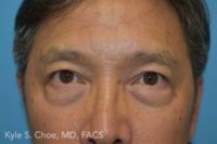 Blepharoplasty (Eyelid Surgery)