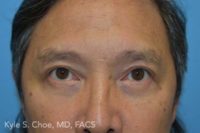 Blepharoplasty (Eyelid Surgery)