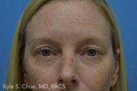 Blepharoplasty (Eyelid Surgery)