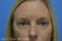 Blepharoplasty (Eyelid Surgery)