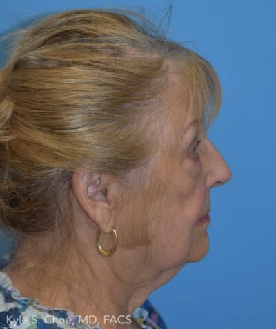 Blepharoplasty (Eyelid Surgery)