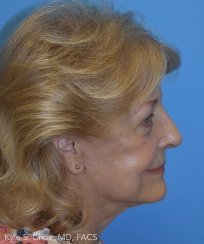 Blepharoplasty (Eyelid Surgery)