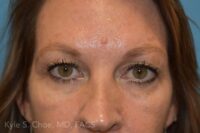 Blepharoplasty (Eyelid Surgery)