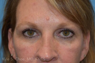 Blepharoplasty (Eyelid Surgery)