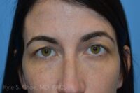 Blepharoplasty (Eyelid Surgery)