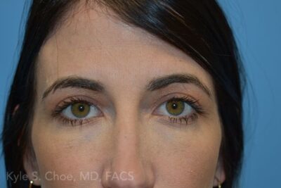 Blepharoplasty (Eyelid Surgery)