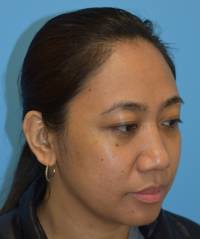 Rhinoplasty