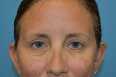 Blepharoplasty (Eyelid Surgery)