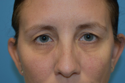 Blepharoplasty (Eyelid Surgery)