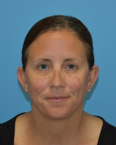 Blepharoplasty (Eyelid Surgery)