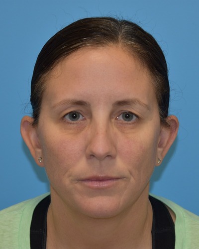 Blepharoplasty (Eyelid Surgery)