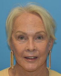 Comprehensive Facial Rejuvenation