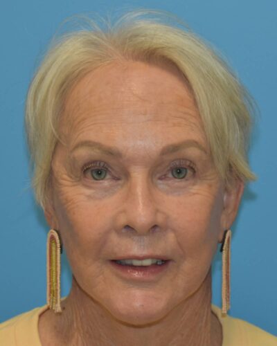 Comprehensive Facial Rejuvenation