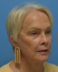 Comprehensive Facial Rejuvenation