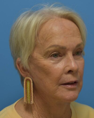 Comprehensive Facial Rejuvenation