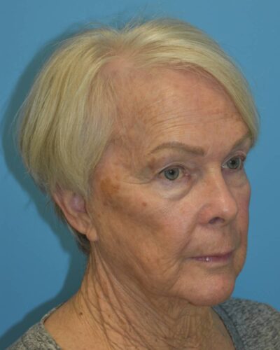 Comprehensive Facial Rejuvenation