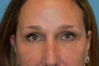 Endoscopic Brow Lift