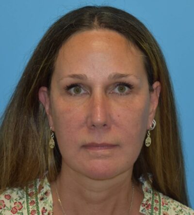 Endoscopic Brow Lift