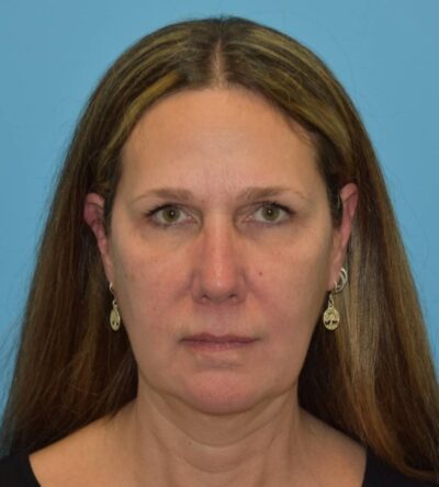 Endoscopic Brow Lift