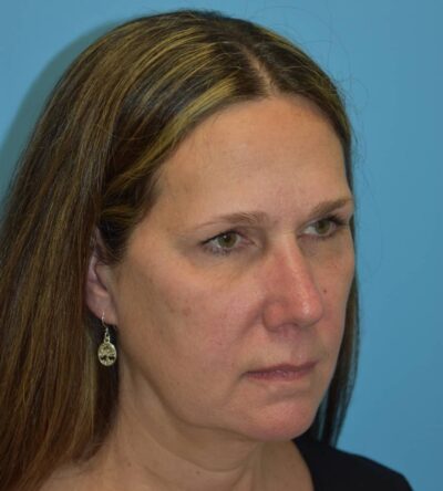 Endoscopic Brow Lift